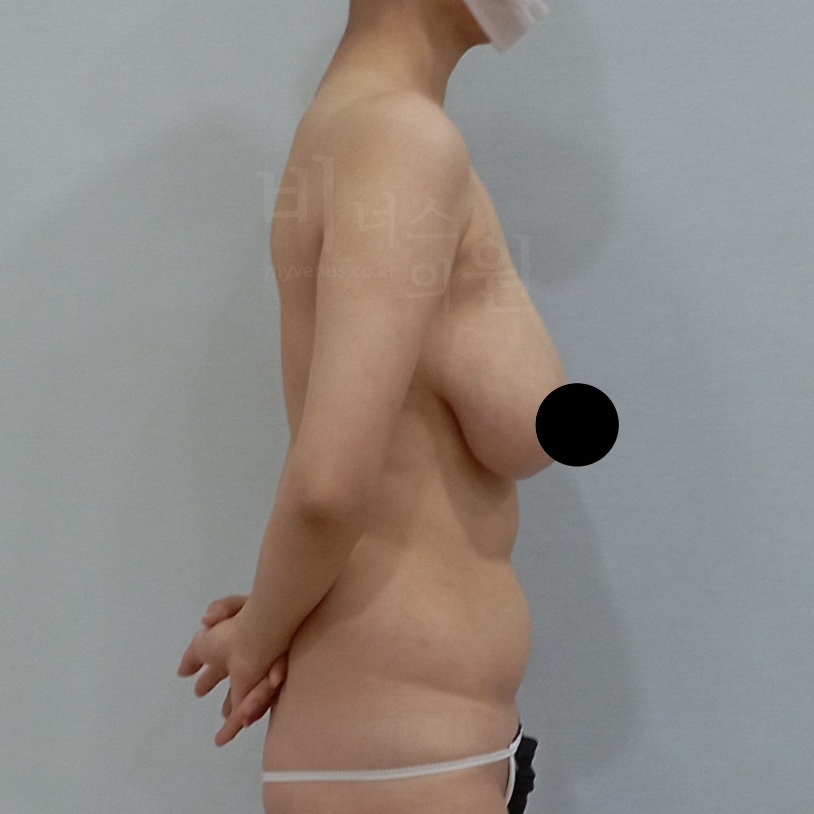 Breasts sagging after childbirth, before breast reduction liposuction, right side