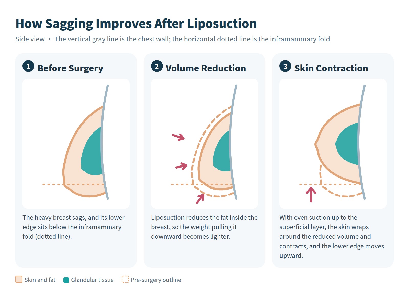 Diagram of how volume reduction and skin contraction after liposuction help improve sagging