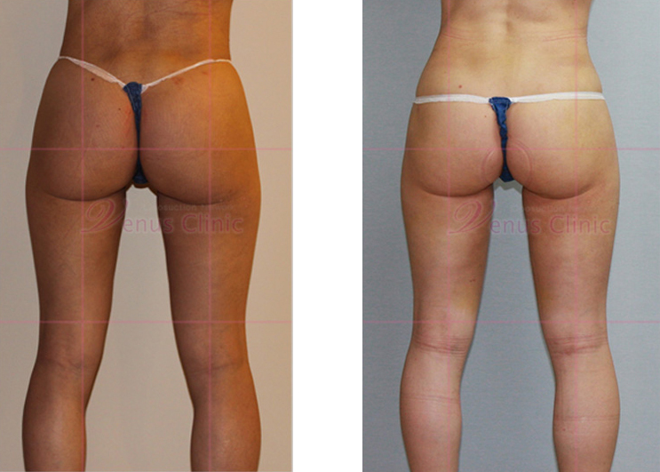 Buttock and thigh reduction liposuction 3