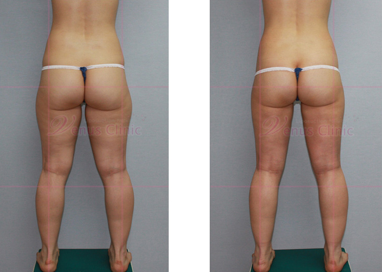 Buttock and thigh reduction liposuction 1