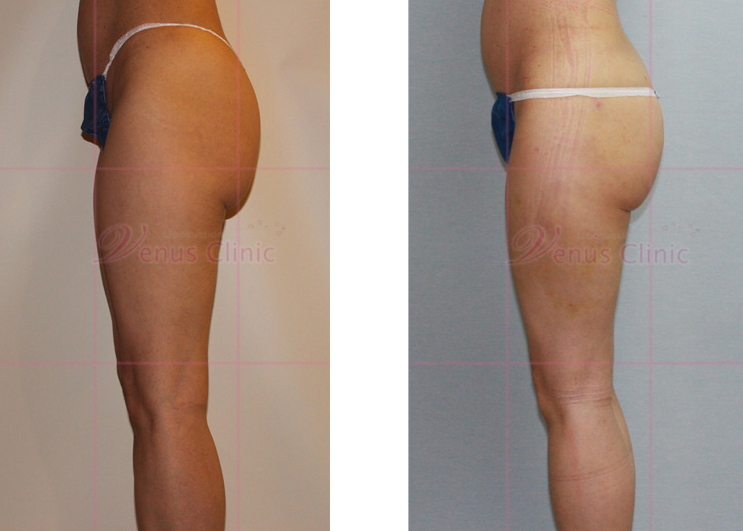 Buttock and thigh reduction liposuction 4
