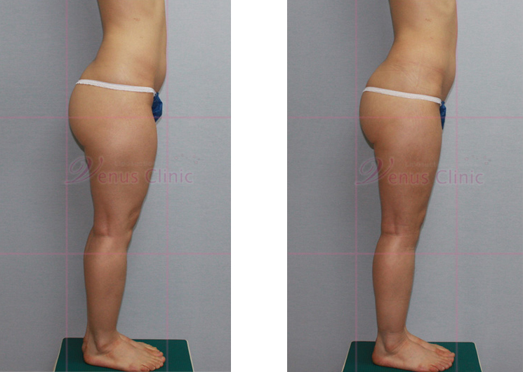 Buttock and thigh reduction liposuction 2