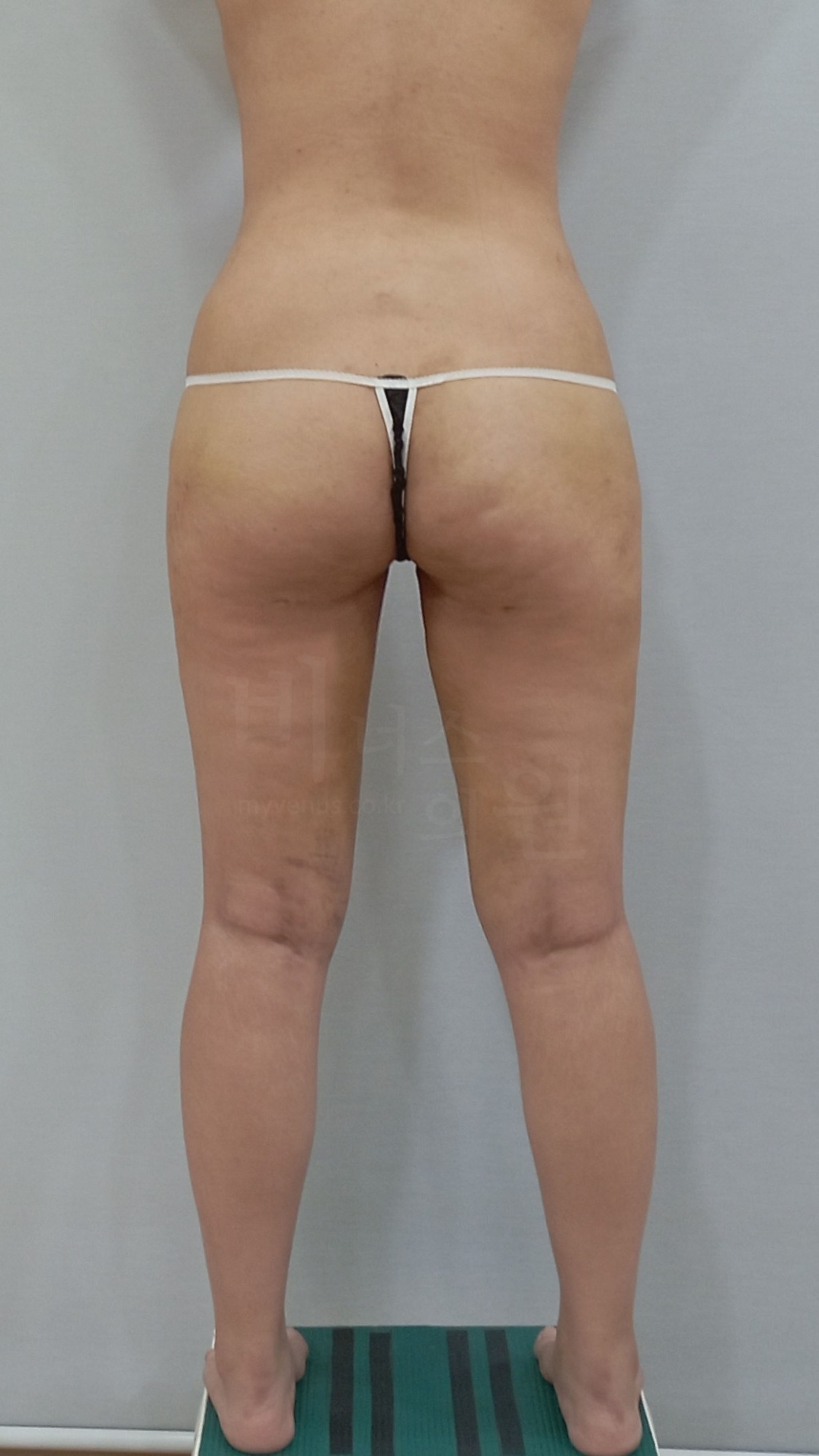 1 week after tumescent liposuction of the thighs and buttocks, back view