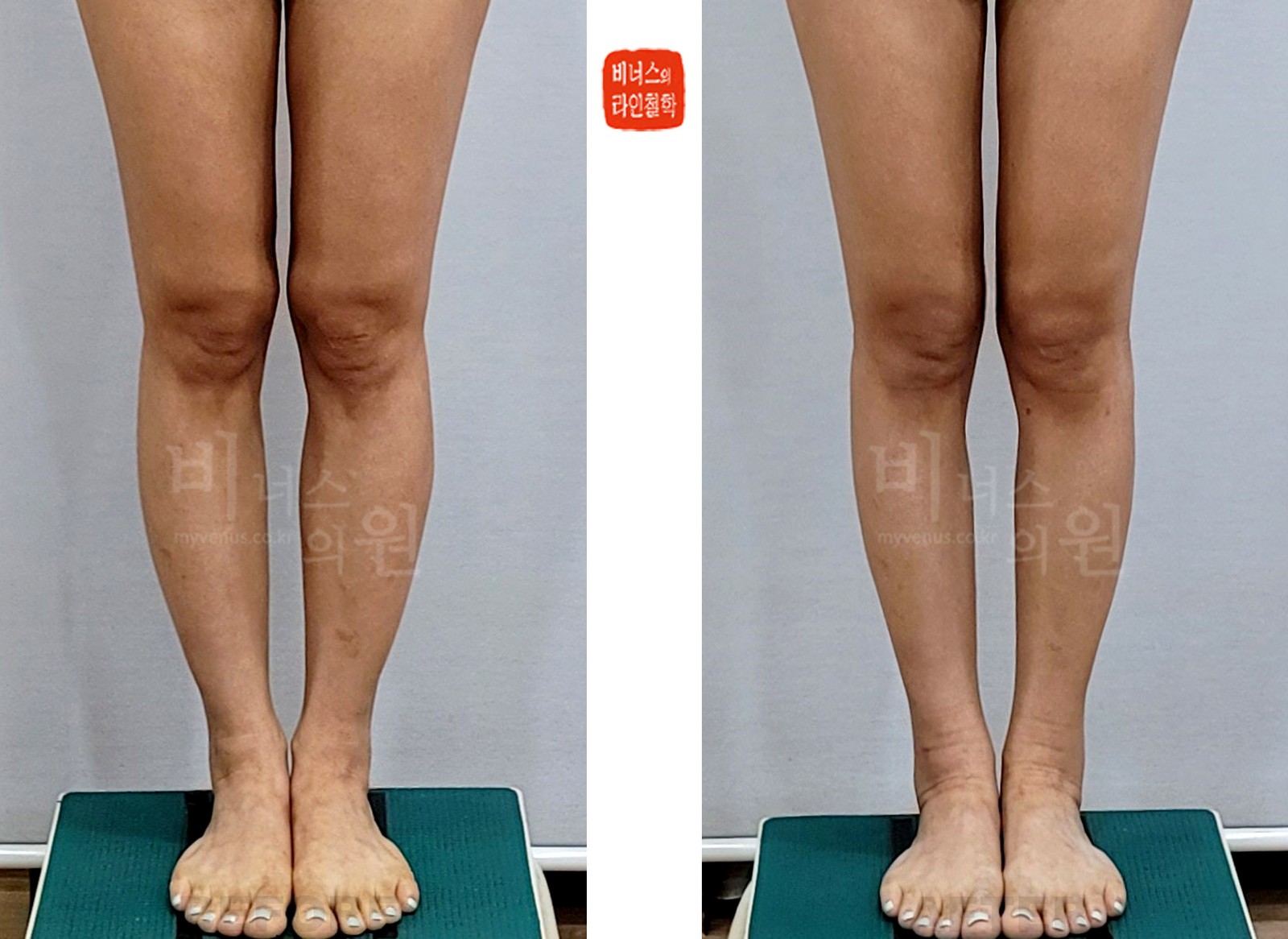 Before-and-after photos of knee, calf and ankle liposuction, front view (1 week after surgery)