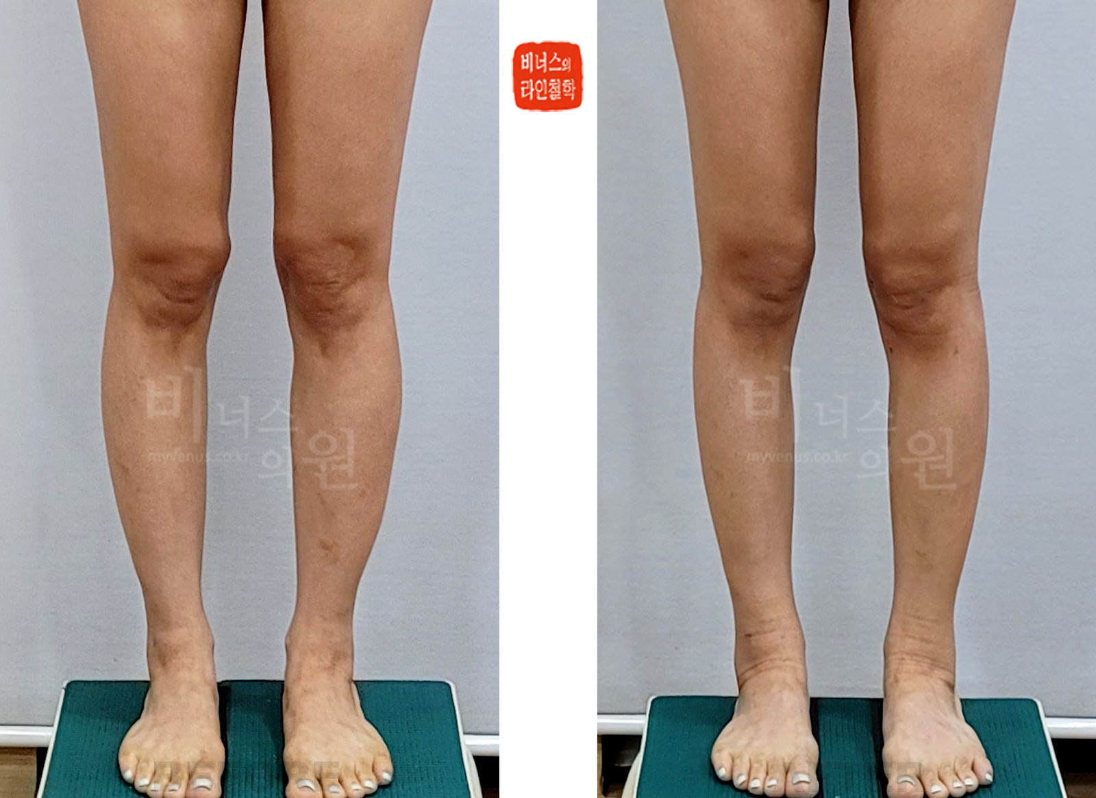 Before-and-after photos of knee, calf and ankle liposuction, second front view (1 week after surgery)