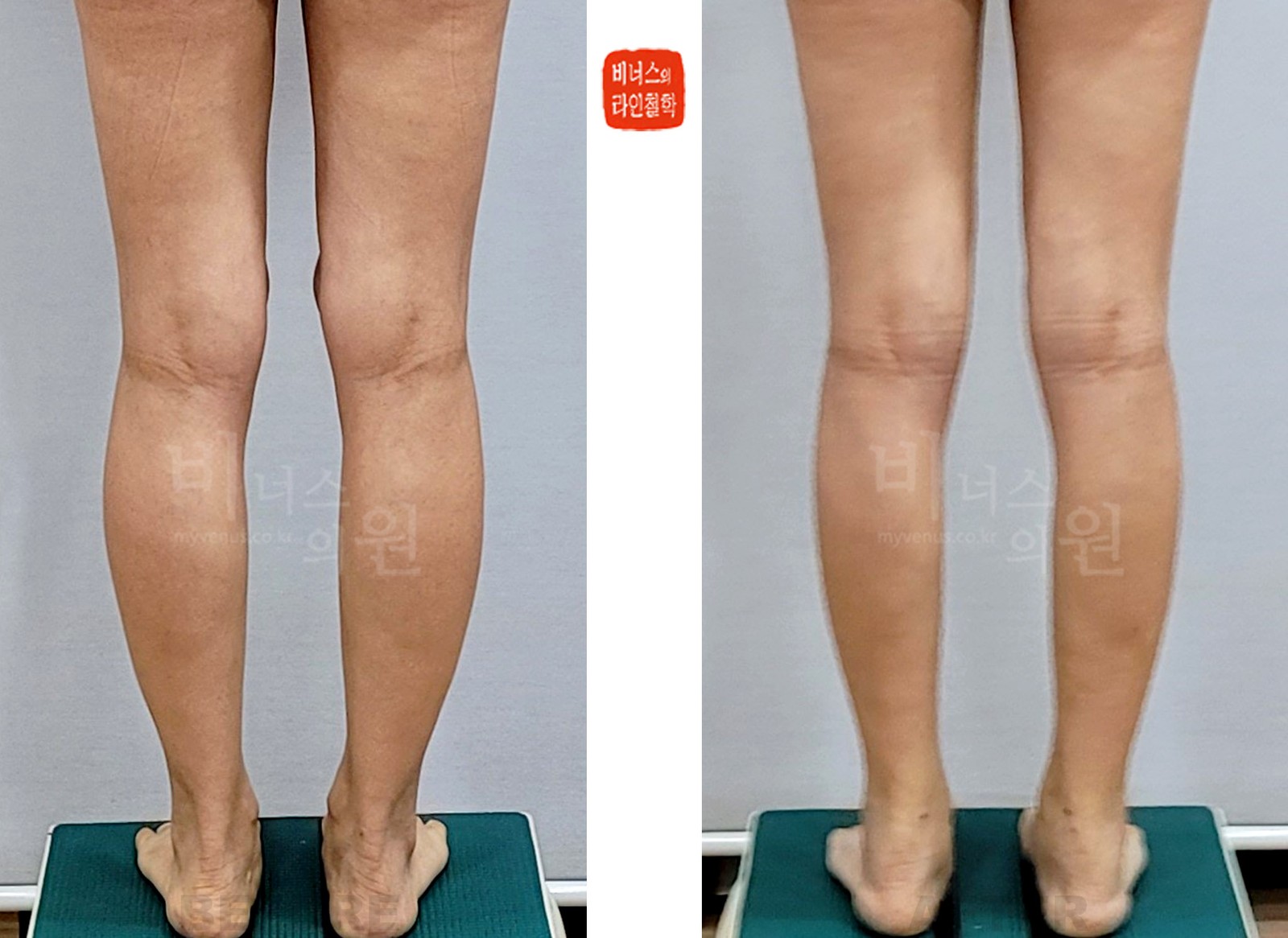 Before-and-after photos of knee, calf and ankle liposuction, back view (1 week after surgery)