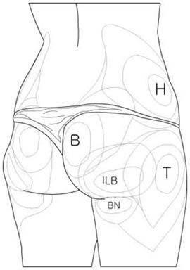 Buttock liposuction areas