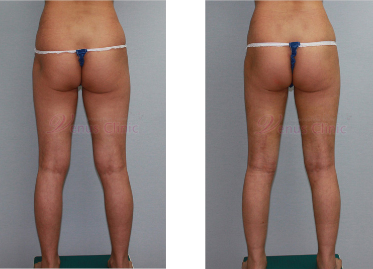 Buttock fat grafting
