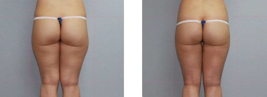 Buttock hip-up surgery
