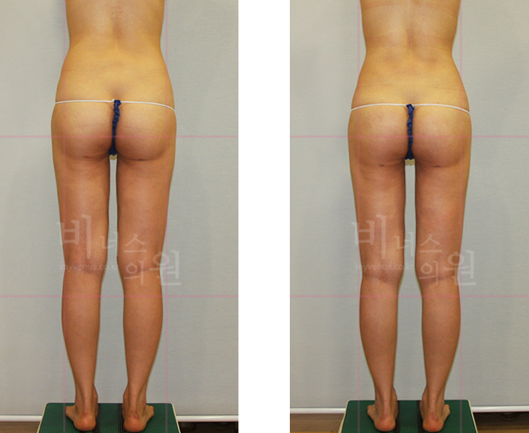 Buttock liposuction revision 1