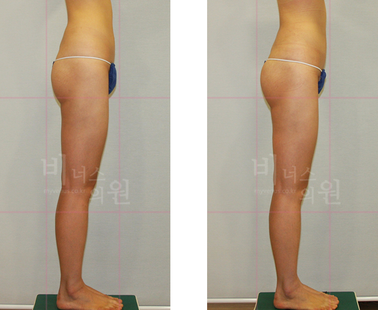 Buttock liposuction revision 2