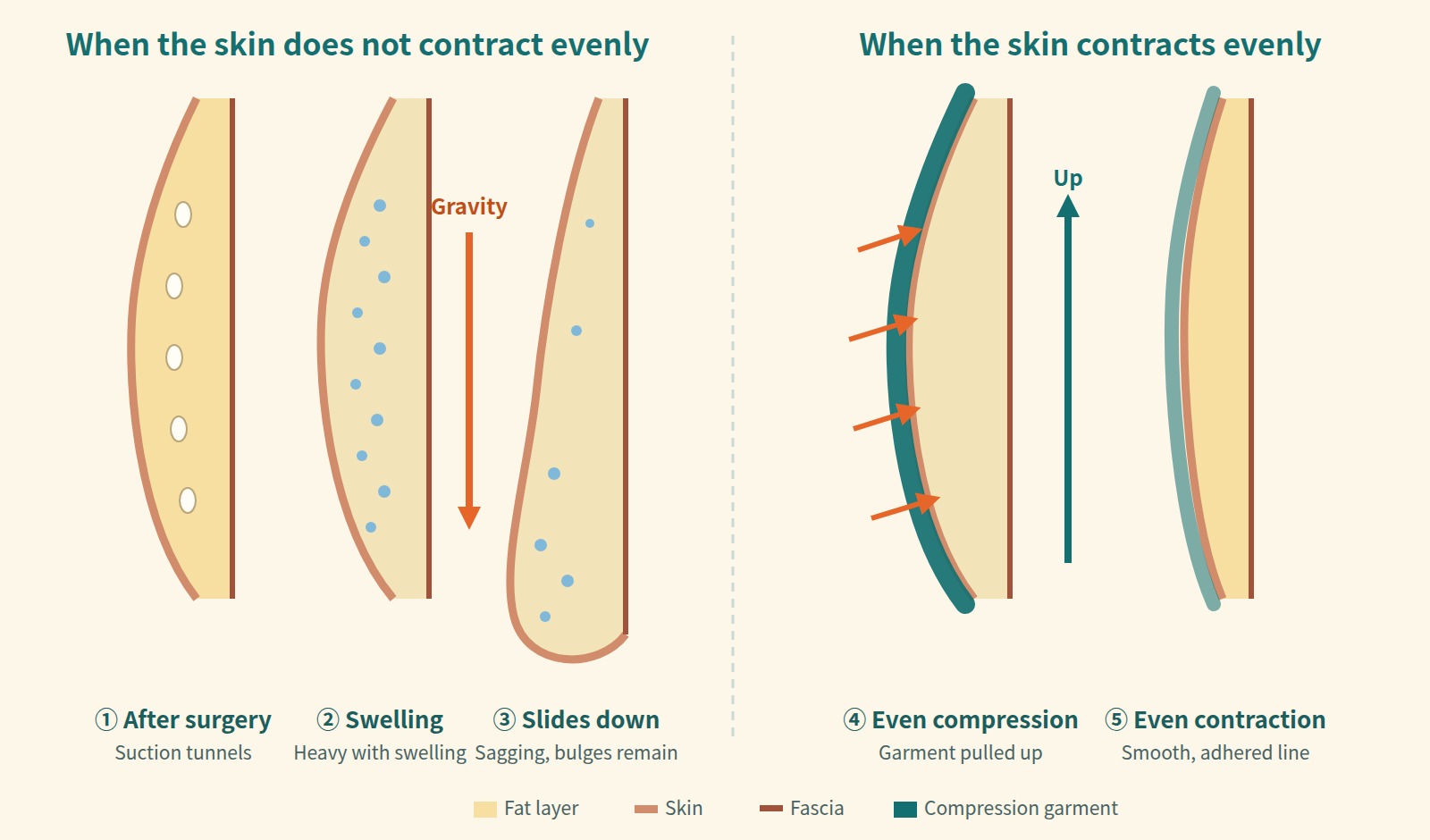 Cross-sectional diagram showing how sagging and bulging remain when the skin does not contract evenly, and how the skin contracts evenly with even compression from a compression garment