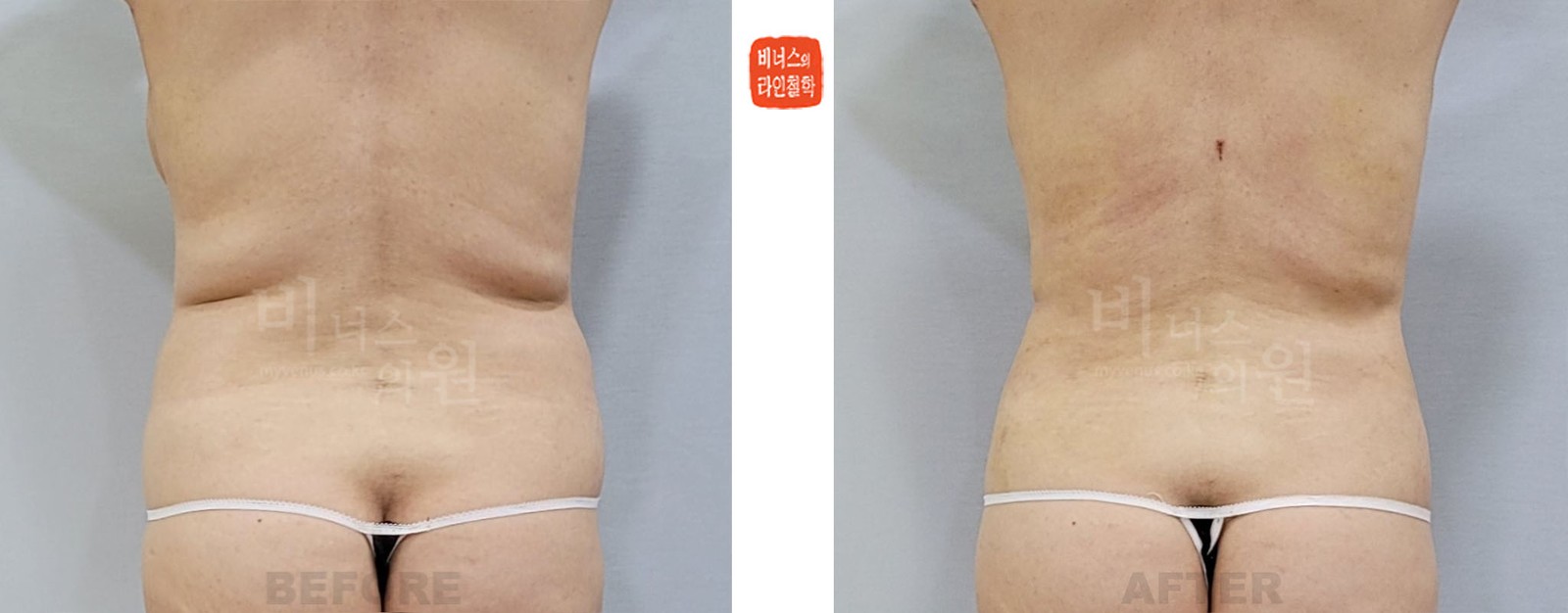 Abdominal revision and back liposuction before-and-after photo, back view (2 weeks after surgery)