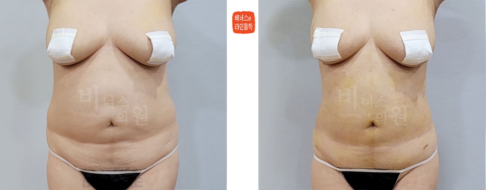 Abdominal revision liposuction before-and-after photo, front view (2 weeks after surgery)