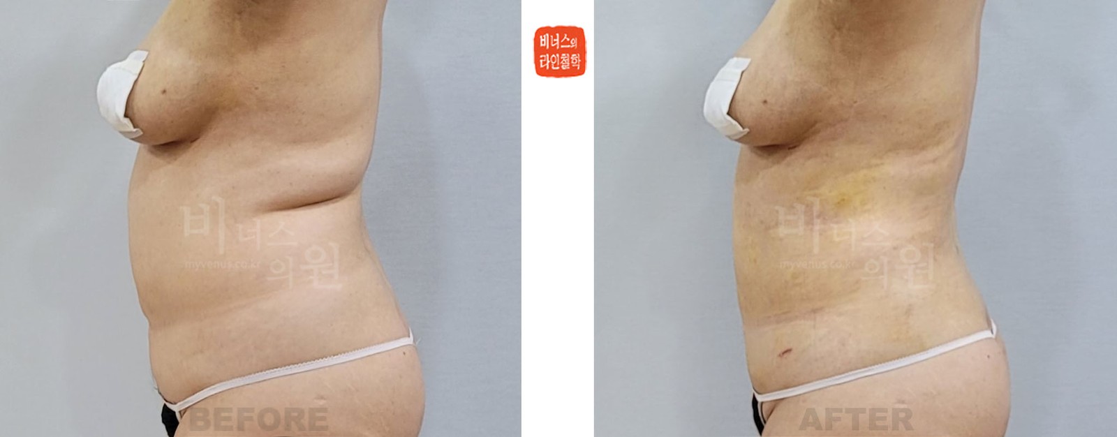 Abdominal revision liposuction before-and-after photo, side view (2 weeks after surgery)