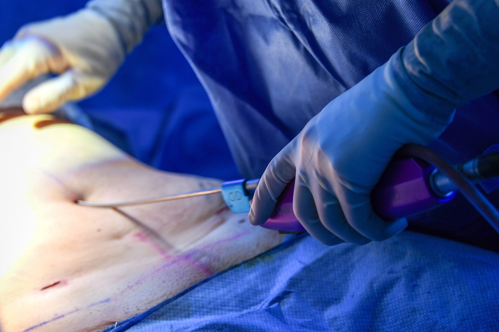 Power-assisted liposuction using a motor-driven cannula