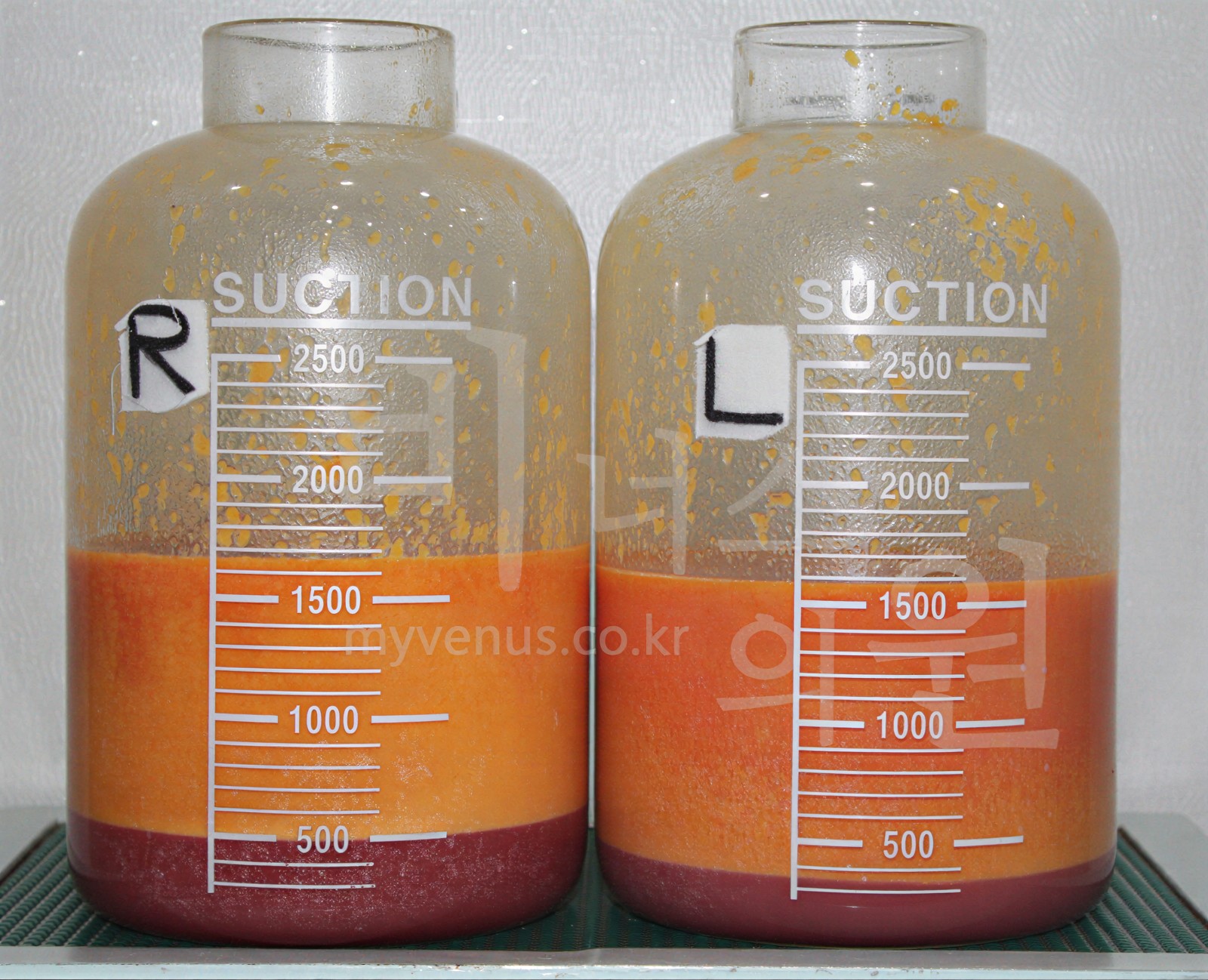 Collection container in which fat and solution suctioned by tumescent liposuction have separated into layers