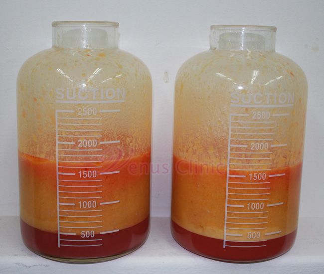 040106_3.jpg Fat removed by liposuction