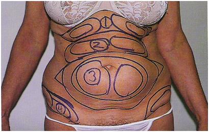 Names of the abdominal subregions