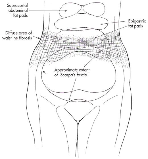 Fibrous tissue in the abdominal fat layer