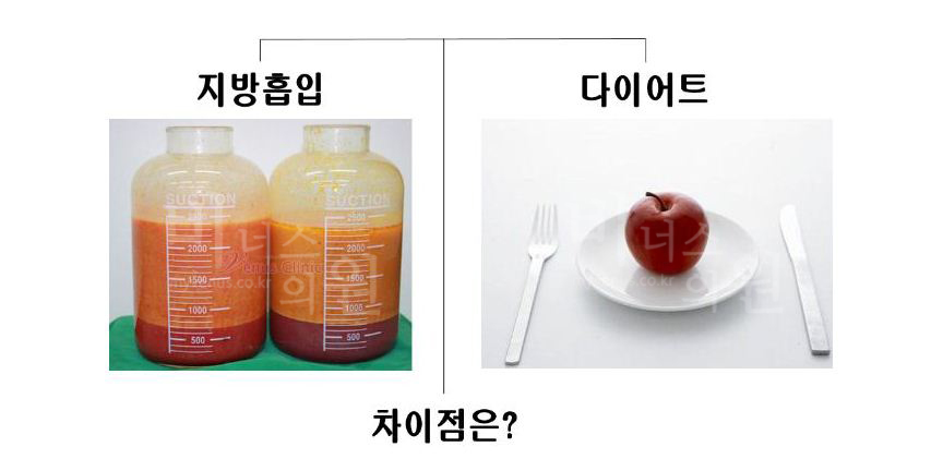 Liposuction vs. dieting