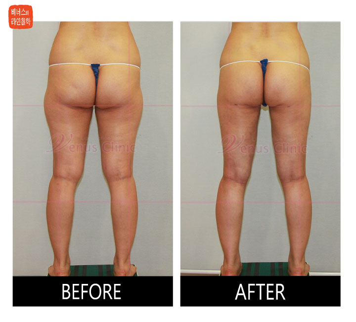 case4_thigh (5).jpg