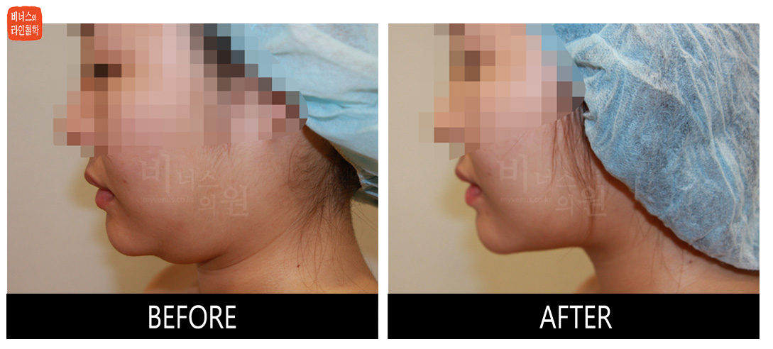 liposuction photos of face and neck9