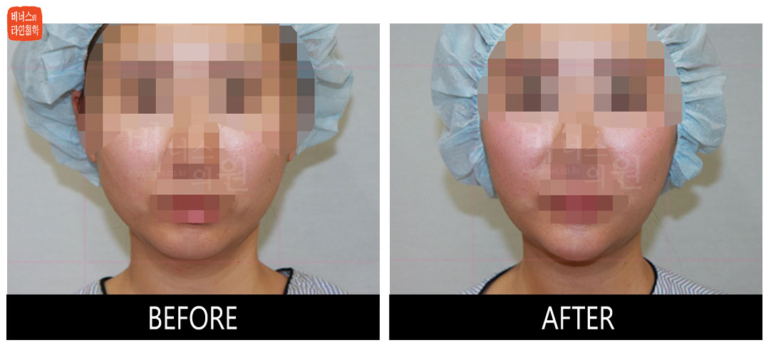 liposuction photos of face and neck10