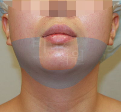liposuction photos of face and neck2