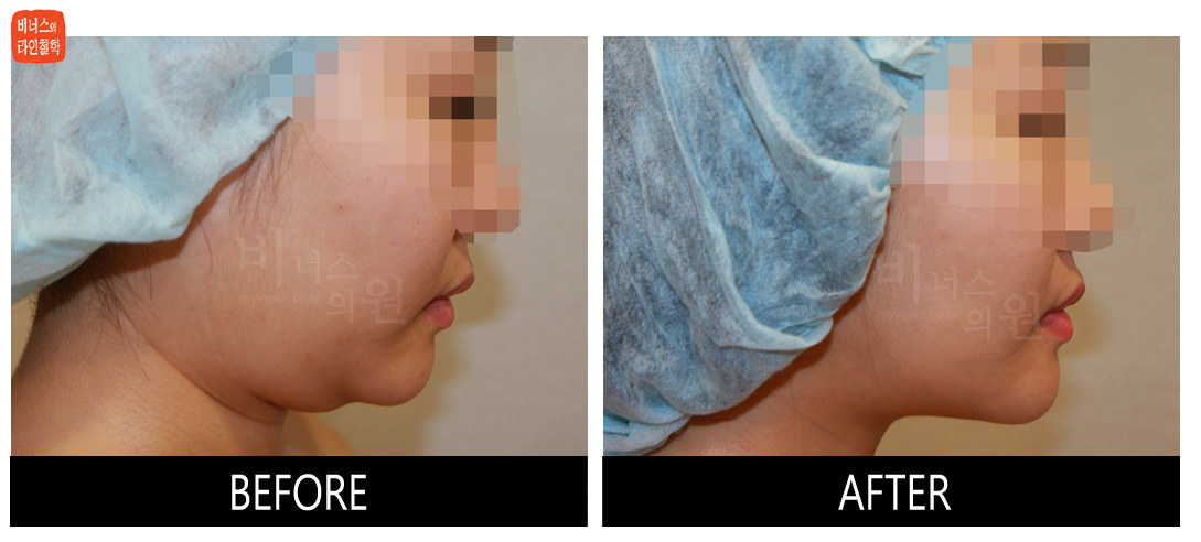 liposuction photos of face and neck8