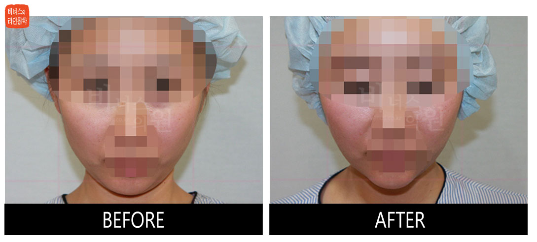 liposuction photos of face and neck11