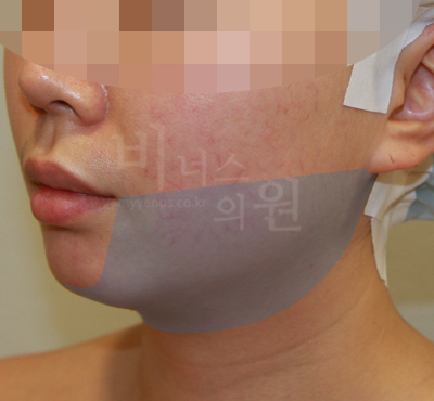 liposuction photos of face and neck3