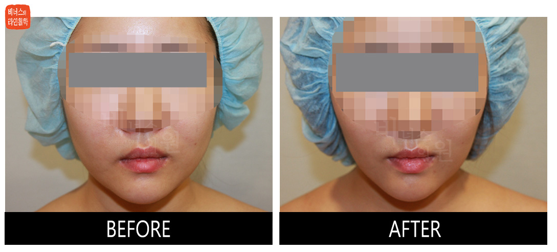 liposuction photos of face and neck7